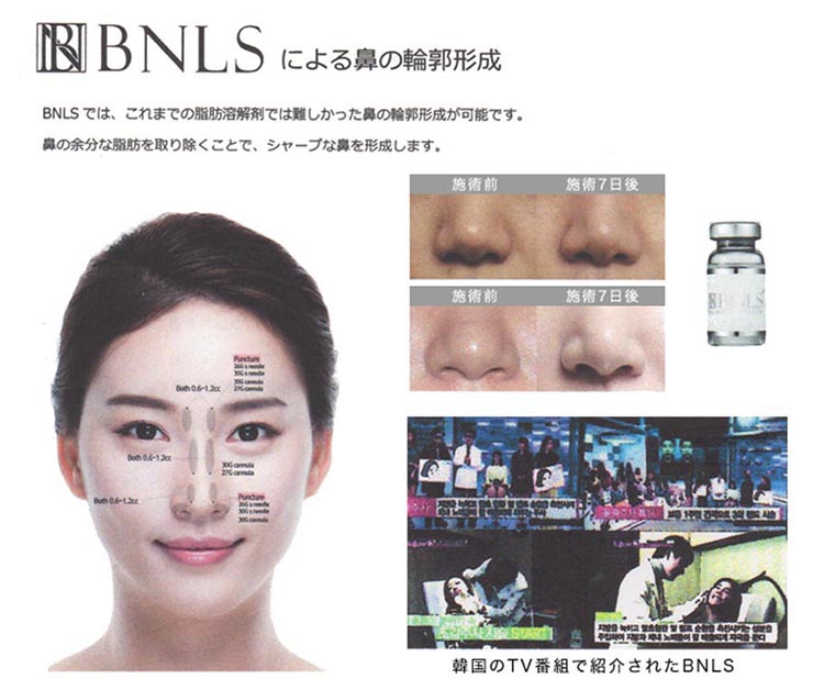 BNLSによる鼻の輪郭形成