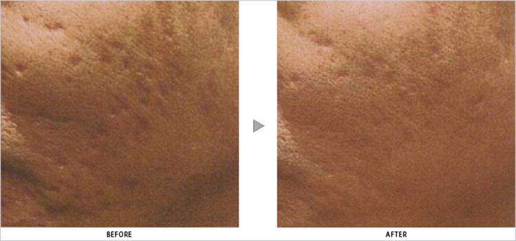 座瘡瘢痕の改善と微小穿孔痕