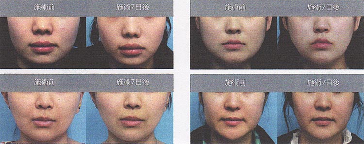 症例1～4