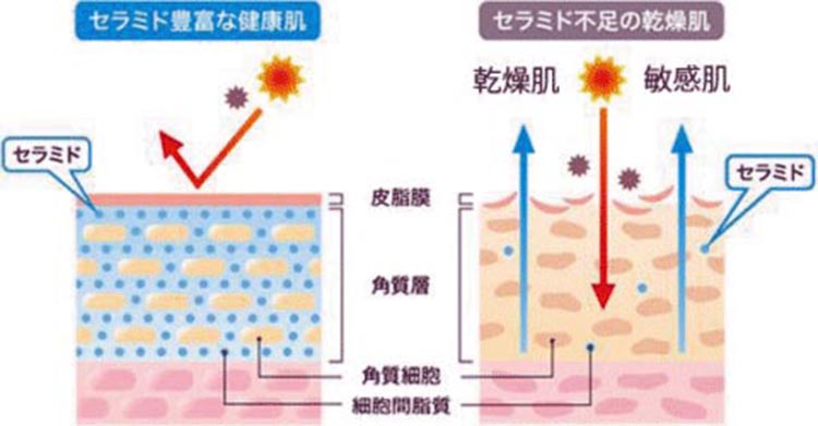 セラミド豊富な健康肌とセラミド不足の乾燥肌比較図