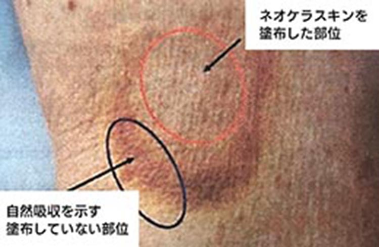 ネオケラスキンを塗布した部位と自然吸収を示す塗布していない部位の比較画像